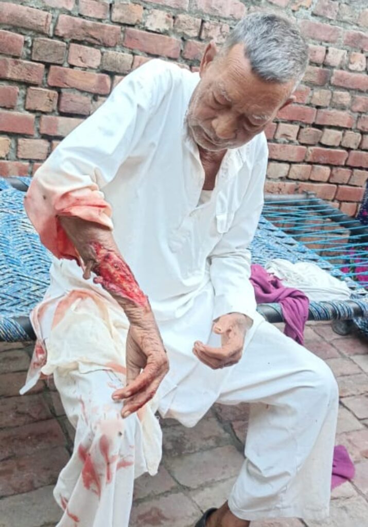 तालाब किनारे टहल रहे बुजुर्ग पर मगरमच्छ ने किया हमला, हायर सेंटर किया रेफर